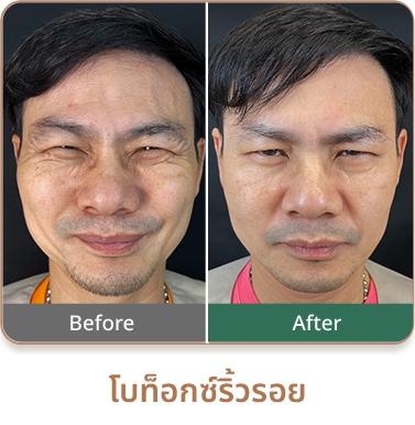 botox review1