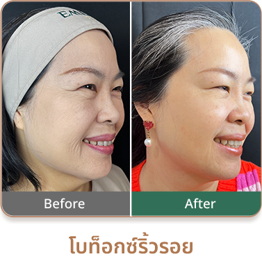 botox review2