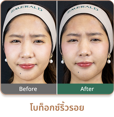 botox-review3-1